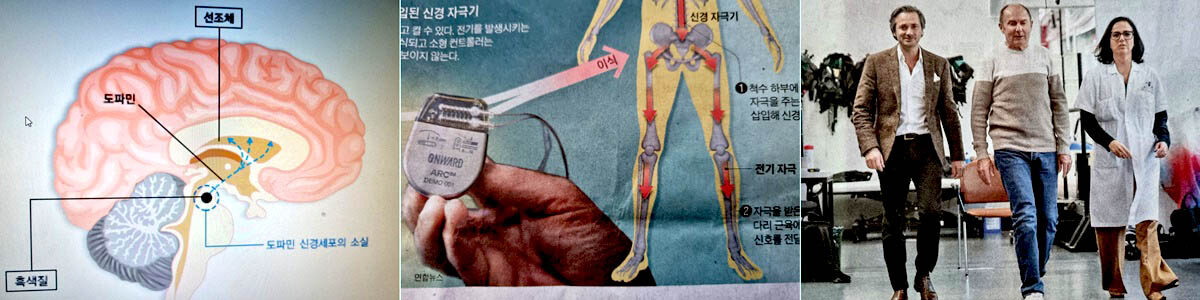 파킨슨 병에 대해서.jpg